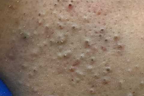 [ASMR] Facial Care Routine for Pimple and Blackheads Removal, Satisfying Skincare